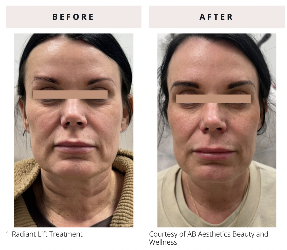 Radiant Lift b_a 2