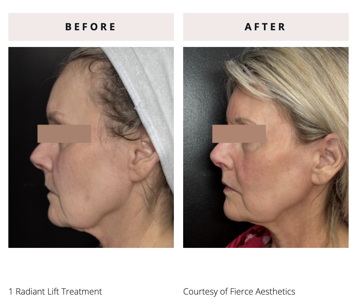 Radiant Lift b_a 3
