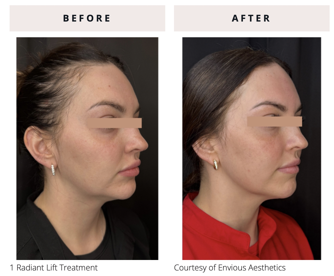 Radiant lift B_A